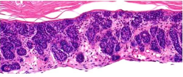 pathway and histology showed large basaloid nests Control