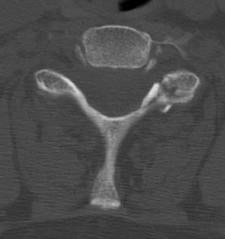Lower Cervical Spine Isolated minor fractures Vertebral