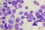 Pure Red Cell Aplasia A related disease Failure to make red cells (energy) but white cells and platelets normal Bone