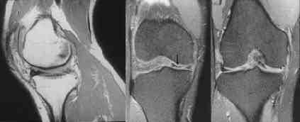 but this was also seen in other types of tear, including three which were longitudinal and one which was peripheral (Fig. 4). The double PCL sign was found only in medial meniscal tears.