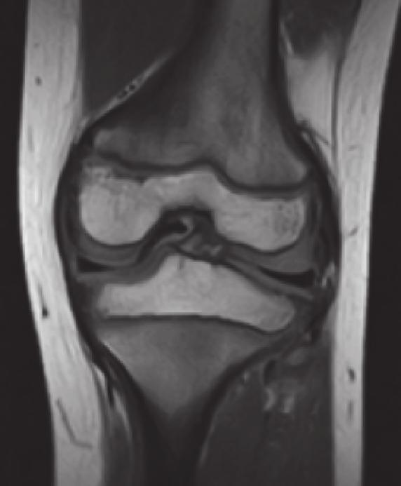 2 Case Reports in Orthopedics (c) (d) Figure 1: T1-weighted magnetic resonance images. Coronal (a, b) and sagittal (c, d) sections showing normal findings of the lateral meniscus.