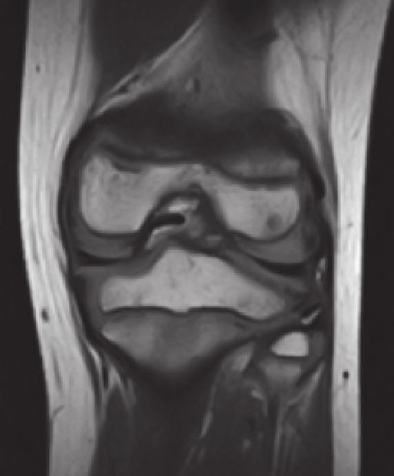 The second semicircular meniscus of the left knee was resected arthroscopically, resulting in the complete relief of symptoms.