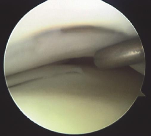 A second semicircular meniscus is seen under the original lateral meniscus.