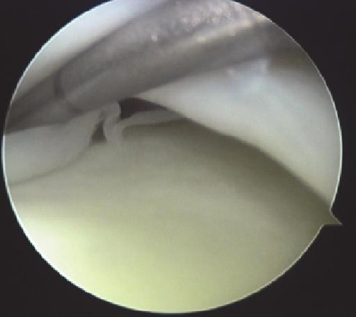 Figure 3: Histological findings of the second semicircular meniscus.