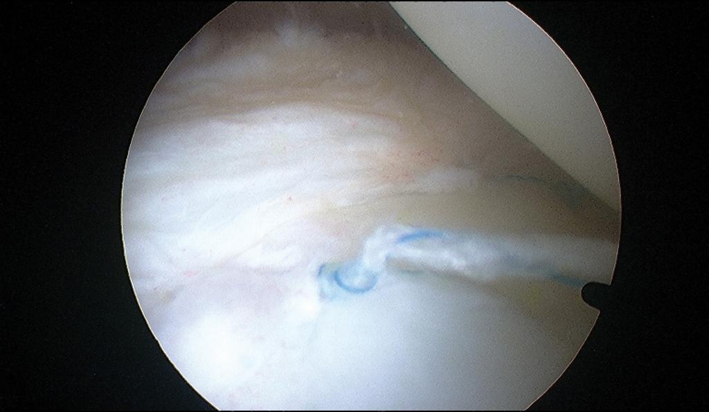 1a of the peripheral junction 4. Later Beaufils et al extended this cut-off to 4 mm for arthroscopic repair, provided that the tear is located into the red-red zone 5.