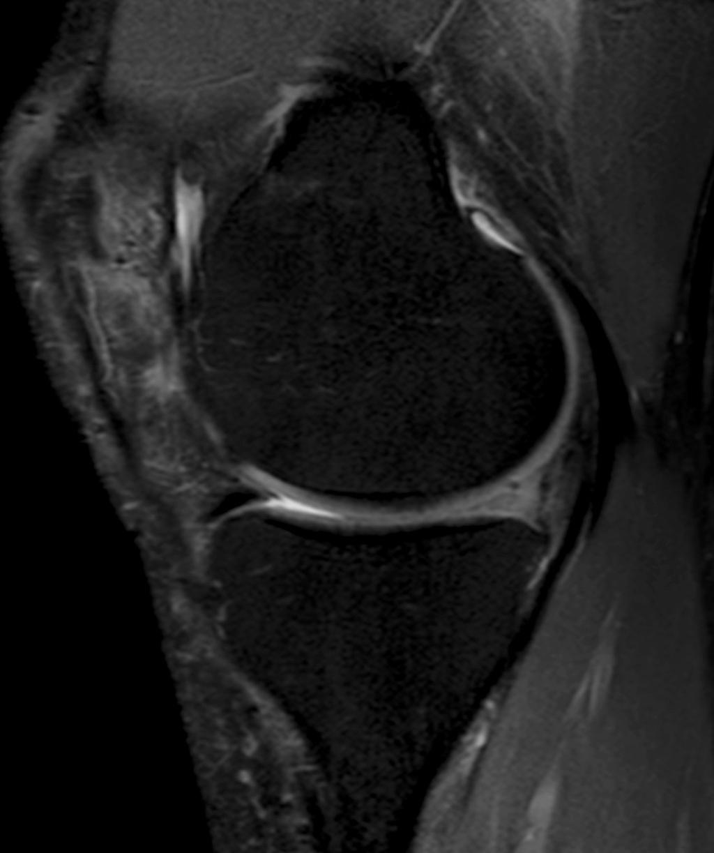 Conversely, PRP administration at the end of open meniscal repair improved clinical outcomes at 24 months follow-up in a casecontrol study 17.