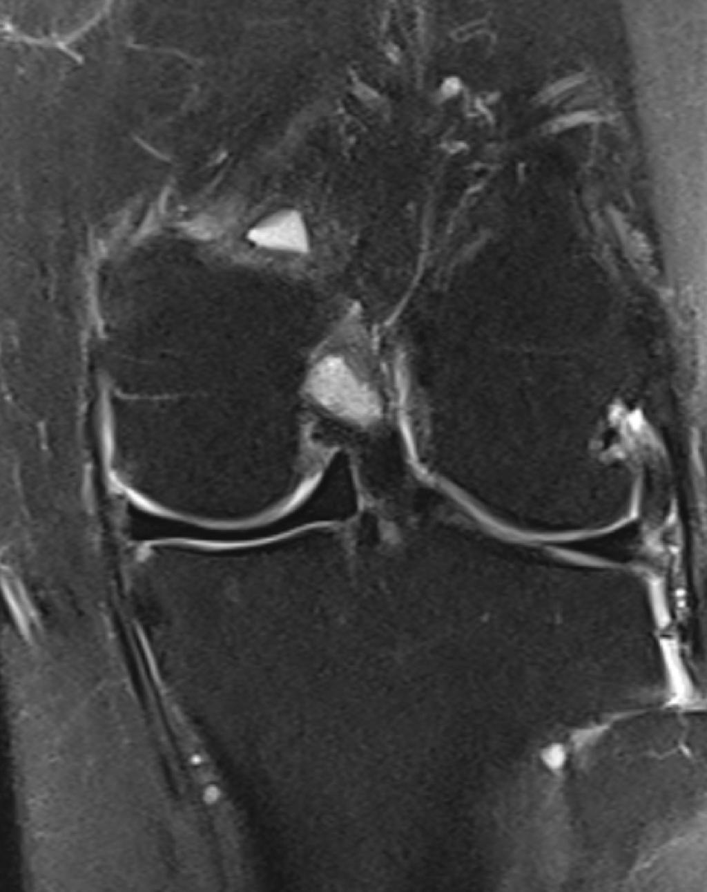 4a 4b Figure 4a: Coronal MRI of a lateral meniscus allograft with bone block. Note the normal signal intensity and the limited extrusion of the graft.