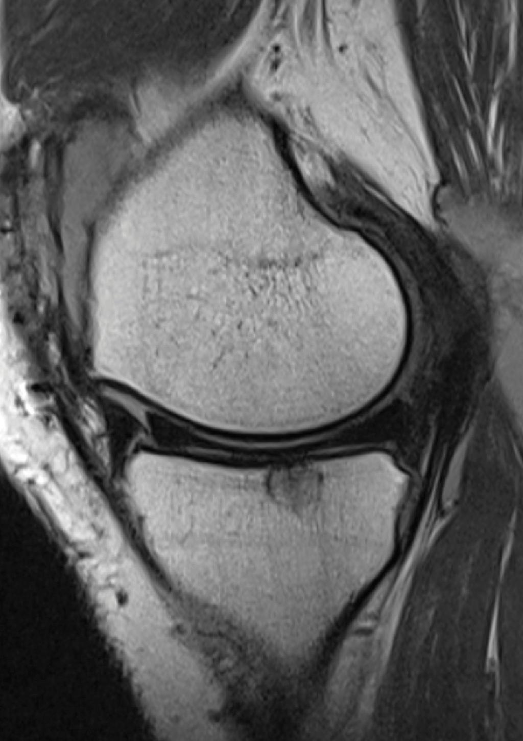 However, the MRI appearance at follow-up raised several concerns in both cases, showing the implants were reduced in size, with a hyperintense signal in most cases.