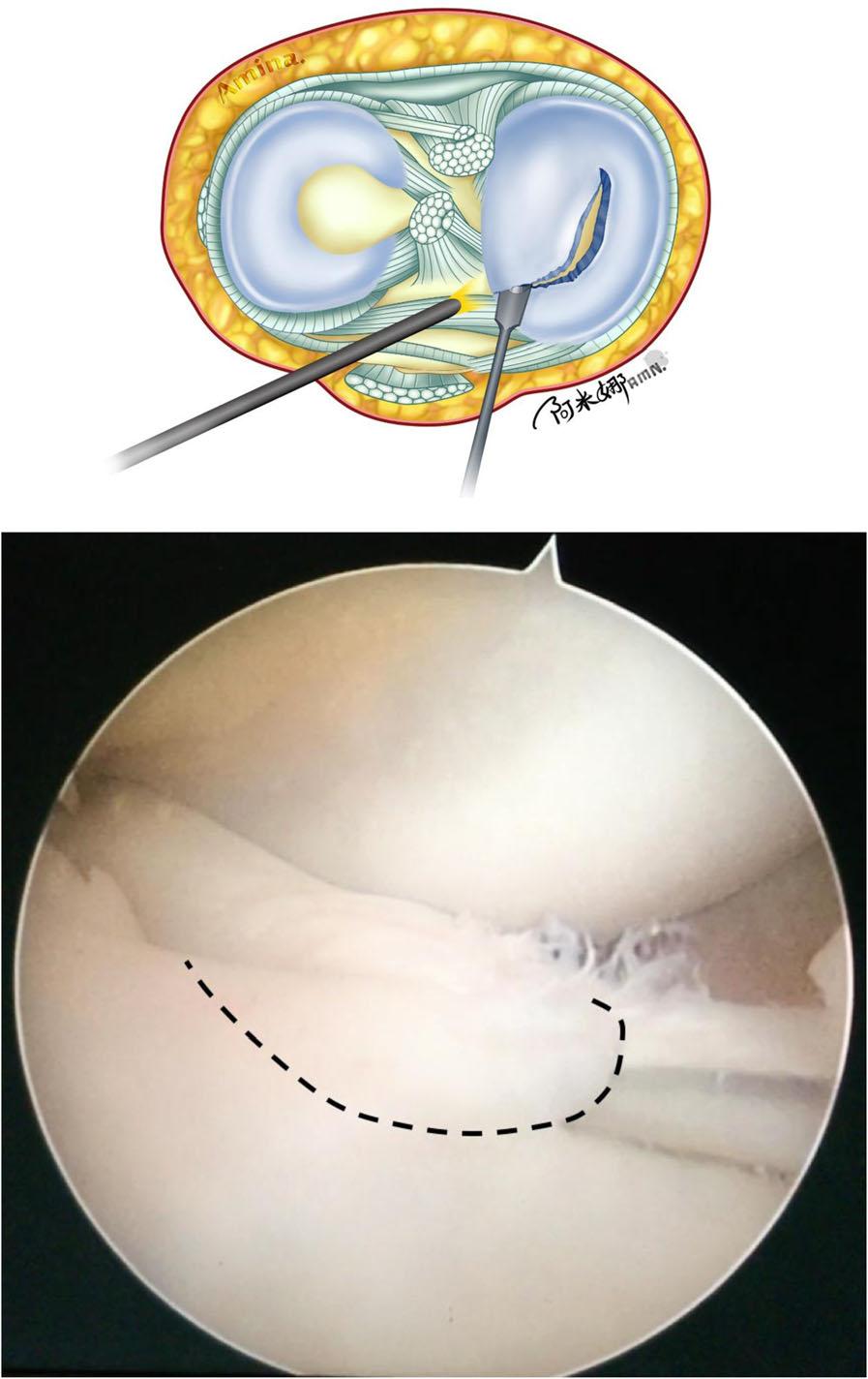 IF inner fragment First, a 30 angle arthroscope is inserted through the high anterolateral portal.