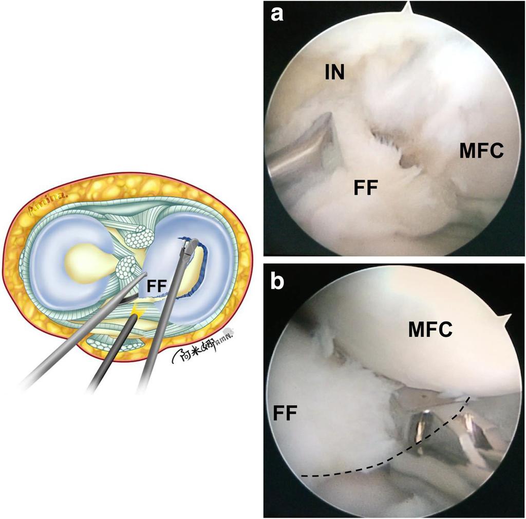 Wang et al. Journal of Orthopaedic Surgery and Research (2017) 12:161 Page 4 of 7 Fig. 4 Illustration and intraoperative photographs showing the cutting of the damaged discoid medial meniscus.