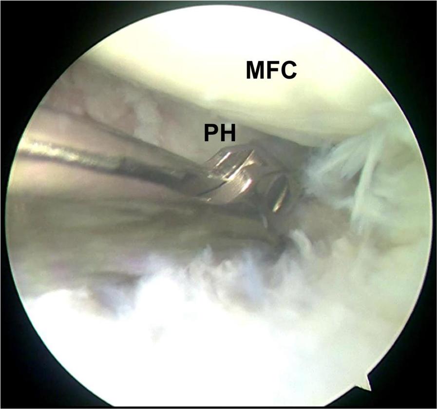 The posterior horn cannot be viewed clearly viewing through anterolateral portal without being pulled forward. So the basket forceps is inserted deeper to cut the posterior portion.