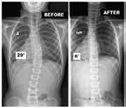 80% Sustained Reduction 12 year old female high risk Risser II primary thoracic scoliosis.