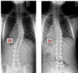 This will reduce existing spinal curvature and significantly decrease the chance that their scoliosis will worsen as they grow.