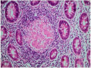 inflammation Non-diffuse crypt distortion Granuloma In biopsies from