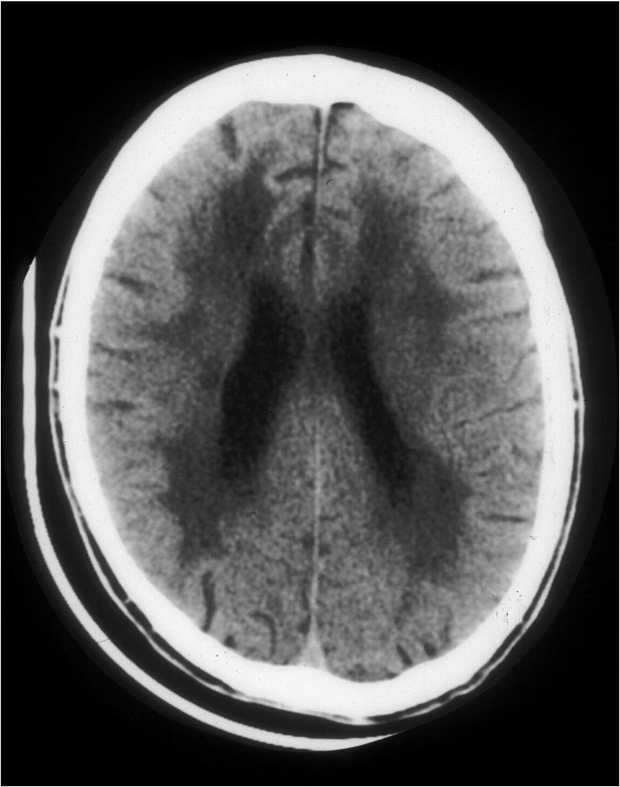 Review, J Vasc Surg 2011;54:227-36 Silent brain infarcts (SBI) SBI s are common in patients at increased risk of stroke