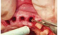 Forcep rotation and the use of Periotomes best allow for predictable atraumatic extraction.
