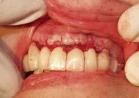 The xenograft material offers the graft site radiopacity and increased