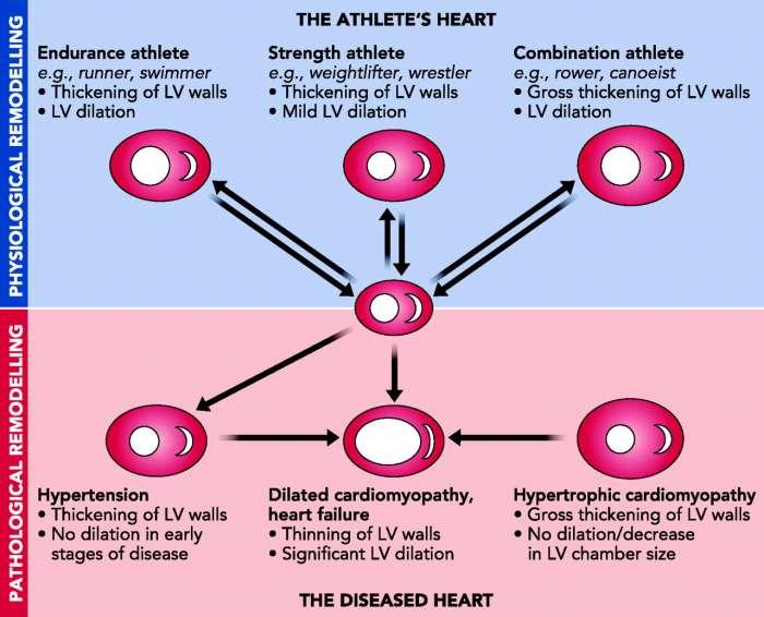 Physiological remodeling of the athlete's heart and pathological remodeling in settings of