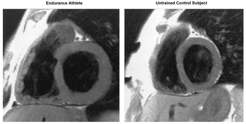 Figure 1 End-diastolic T 1 -weighted short-axis slice from an endurance athlete (left) and an untrained control subject (right).
