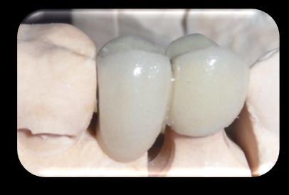 root. During the surgical procedure, for extraction of the UL5, I was able to directly visualise the UL6 mesial