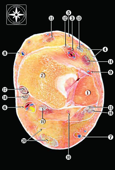 Complications and anatomy 5 Figure 1 Transverse section at the level of the tibiofibular syndesmosis showing important structures susceptible to injury during ankle arthroscopy.