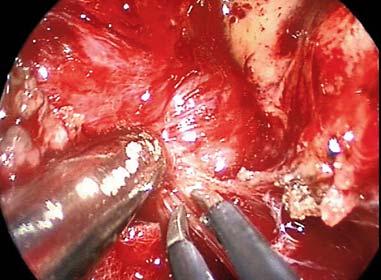 2 3 The KASSAM Range of Bipolar Forceps Field of application: Microscopic Brain and Skull Base Surgery Endoscopic Pituitary Surgery Endoscopic Expanded Endonasal Surgery Endoscopic