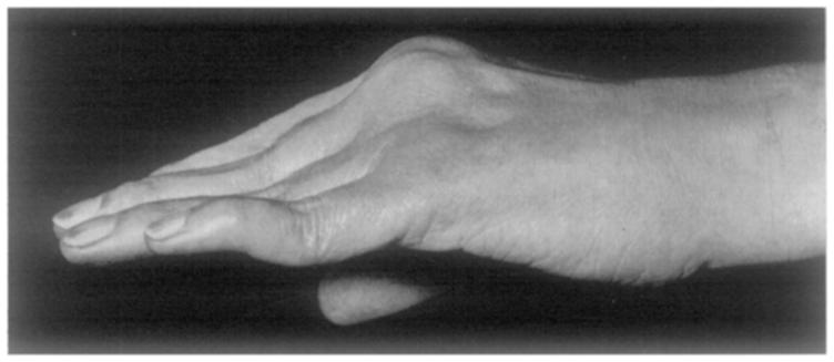 rheumatoid arthritis, without