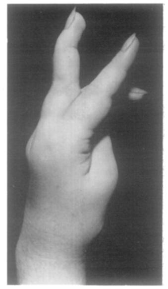 5 Fro. 6 Fig. 4.--Rheumatoid arthritis with classical intrinsic plus deformity. Fig. 5.--Rheumatoid arthritis with deformity resembling intrinsic plus. Fig. 6.--Swan's neck deformity in one finger.