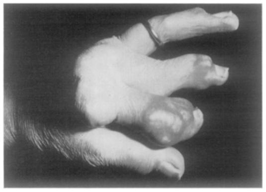 --In mallet finger hyperextension of the proximal interphalangeal joint occurs as a secondary deformity (Fig. 13). The probable cause is FIG. 13 Swan's neck deformity in mallet finger. FIG. 14 Swan's neck deformity in gout.