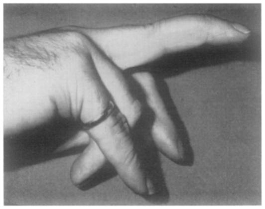 --In this case (Fig. I4) the deformity was due to involvement of the proximal interphalangeal joint. Leprosy.