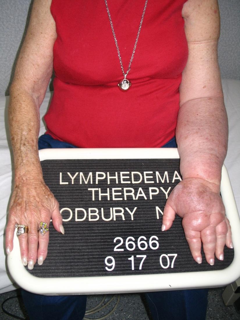 Complications of ALND Lymphedema Shoulder