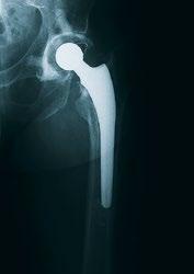 Radiographic Cases Case Study 1 Pre-op: Revision of a loose cemented femoral stem (Paprosky Type 3A) was