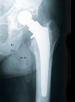 Case Study 2 Pre-op: Revision of a loose cemented femoral stem (Paprosky Type 2) was performed in 1991.