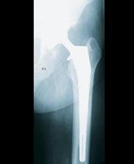 the hip replacement. Restoration of bone density is satisfactory and implant stability is confirmed.