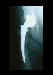 Post-op: A radiograph taken at 2 weeks follow-up shows good stability of the KAR femoral stem, both in the