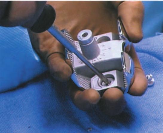 Use femoral counter wrench an jam nut wrench to torque to 120-180lbs (not required for trialing) Assemble femoral augments as necessary by utilizing the 4-mm ball hex driver.