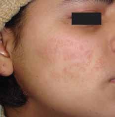 Figure 1 : Post-herpetic scarring before treatment were noted in any patient.