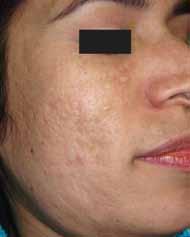 Figure 3: Post-acne scarring before treatment Figure 4: Post-acne scars after dermaroller treatment who had a Grade 3 scarring at the start of treatment [Figure 1] and we were able to reach a stage