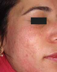 DISCUSSION Microneedling therapy, also known as collagen induction therapy, is a recent addition to the treatment armamentarium for managing post-acne scars.