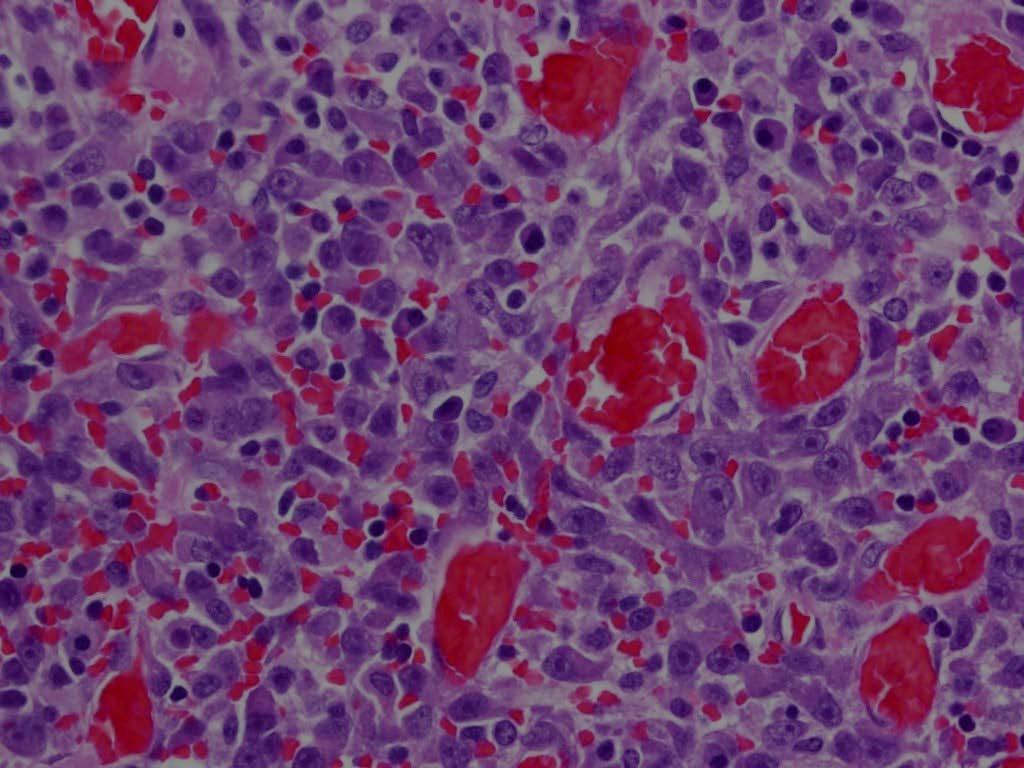 Histologic Features of EIMS Epithelioid to round cells with variable amounts of amphophilic or eosinophilic cytoplasm Minor spindle cell component (<5% of the tumor) Vesicular nuclei with large