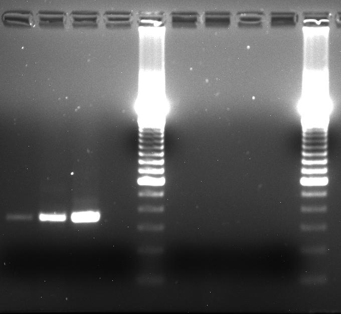 Our Case: Cytogenetics and Molecular Studies ALK FISH: Extra copies of ALK gene and 3 end of