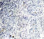 SA-miR Tumour deth & prolifertion Cspse 3 Ki7 Ki7 quntifiction: or SA-miR tumours Ki7+ nuclei % SA-miR Clonl dominnce y mirs (DNA sequencing, cont. Fig.