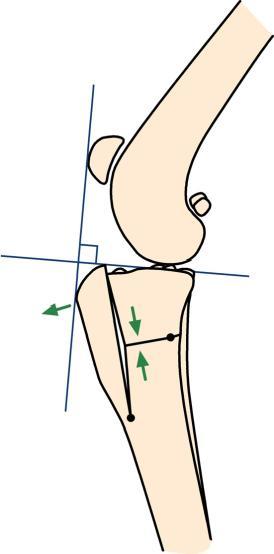 There are two ways to achieve this; i) advance the tibial crest (the basis of the Tibial Tuberosity Advancement (TTA) technique described by Professor Montavon) and ii) alter the alignment of the