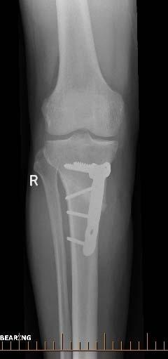 A straight 12-cm incision was created starting at the tibial tubercle medially and continuing distally parallel to the tibial crest exposing the proximal tibia.