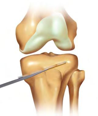 Another line is drawn from the center of the femoral head to a point midway* in the