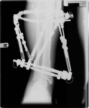 A lateral incision was then made over the fibula with dissection taken down to the shaft. Utilizing a sagittal saw a transverse osteotomy was made.