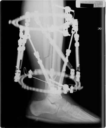 The Foot and Ankle Online Journal Figure 4 Immediate lateral post-operative radiograph showing fibular osteotomy. A case study was reported by Mabit, et al.