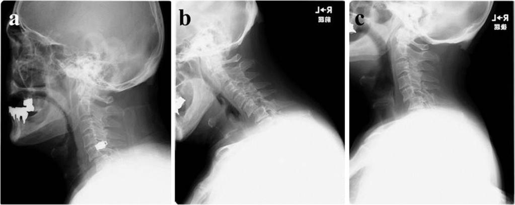 Shimada et al. Journal of Medical Case Reports 2013, 7:9 Page 2 of 5 Figure 1 Plain X-ray film images showing slight spondylolisthesis of C5 immediately after a traffic accident.