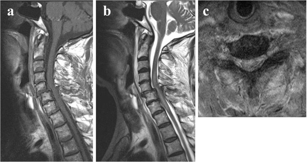 X-ray imaging, MRI and CT eight weeks after the injury (Figures 1a,b,c, 2 and 3).