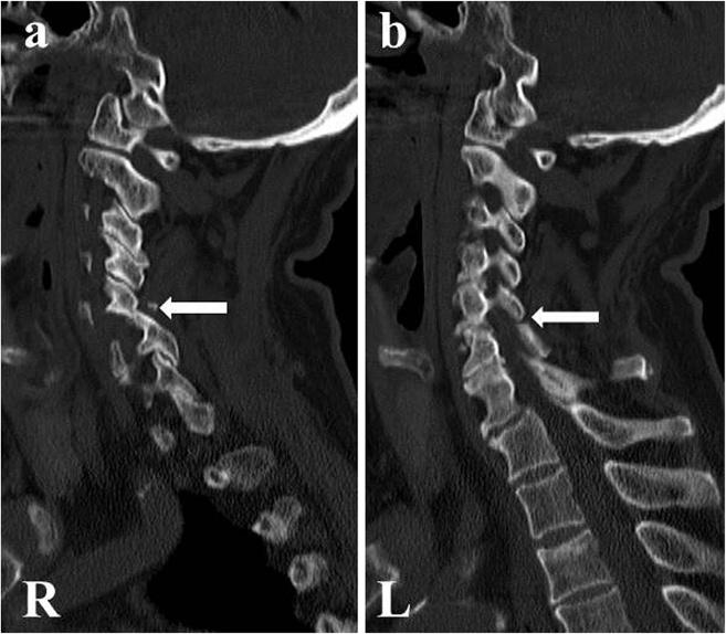 (a) R: right side (arrow). (b) L: left side (arrow). treated by posterior-anterior reduction and fixation. After surgery, bony union was achieved, and our patient s neck pain and arm pain disappeared.
